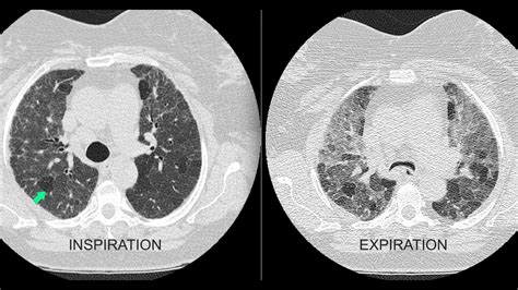 air trapping on ct|air trapping on chest ct.